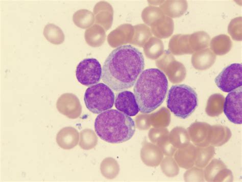 To differentiate between leukemia and a flu or a cold, a senior individual with leukemia may notice one or more of the following symptoms: Myelogenous leukemia, acute. Causes, symptoms, treatment ...