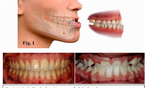 Cambios Dramáticos En La Mordida Clase 3 Antes Y Después Blog Dental