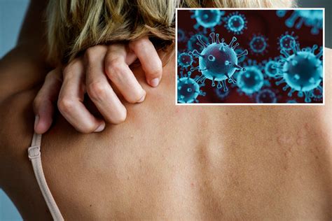 Skin Rashes Could Be Potential Sign Of Coronavirus Dermatologists Warn