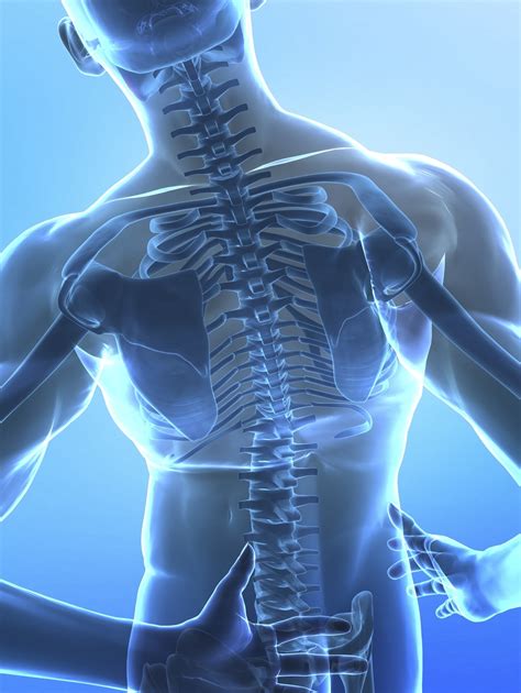 Broken back - Answers on HealthTap
