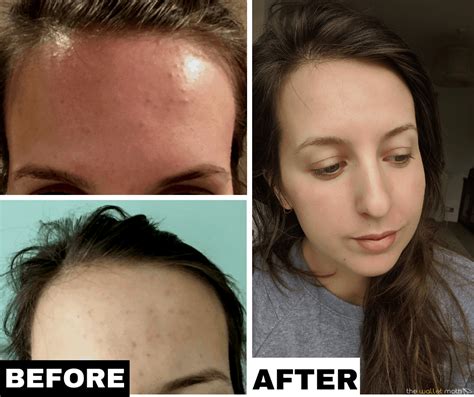 How I Cleared My Tiny Bumps On Forehead Once And For All Forehead