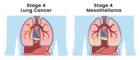 Pleural Mesothelioma Vs Lung Cancer Diagnosis And Treatment