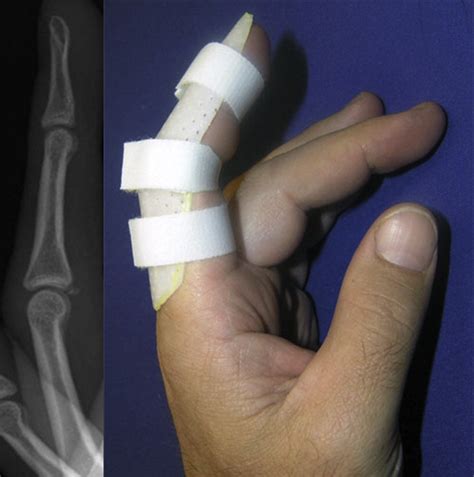 Treatment Of Phalangeal Fractures Hand Clinics