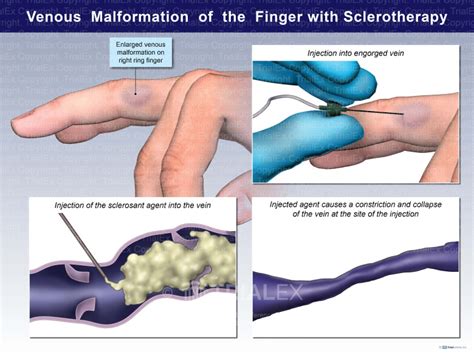 Venous Malformation Of The Finger With Sclerotherapy Trialexhibits Inc