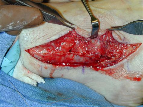 Peroneal Tendon Dysfunction Why Peroneal Tendon Tears Should Be Treated Like Posterior Tibial