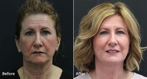 Avoiding A Botched Neck Lift What You Need To Know New Jersey