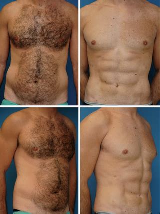 Use a credit card with an introductory 0% apr offer. Plastic Surgeons Use Abdominal Etching to Create Six Pack