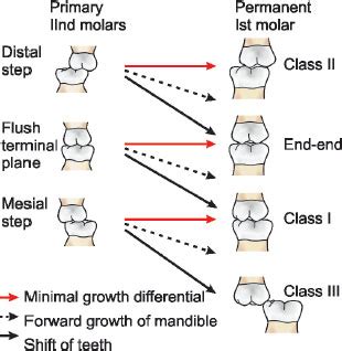 We did not find results for: Student in 2.0: Mesial Step Occlusion