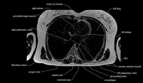 The first is the pectoralis major which is the largest one and located in the center of the chest. chest anatomy | MRI chest (thorax)axial anatomy | free cross sectional anatomy