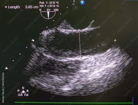 Echocardiography Ultrasound Machine Doppler Of Aortic Stenosis Stock