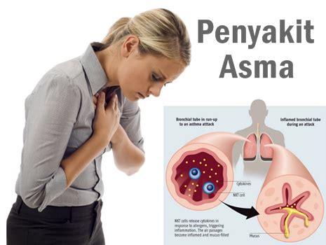 Selain kecubung untuk obat bius alami ada juga cara membuat obat bius semprot sendiri yang khasiatnya sangat ampuh untuk membuat orang pingsan dan tidak sadarkan diri selama pengaruhnya masih ada di dalam orang yang terkena pembiusan. 10 Gangguan dan Penyakit Pada Sistem Pernapasan - masyog.com