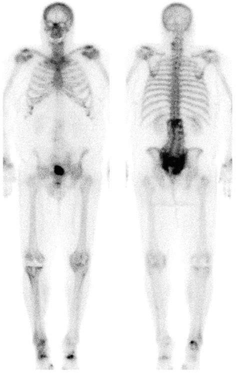 Use Of Spectct With 99mtc Mdp Bone Scintigraphy To Diagnose Sacral