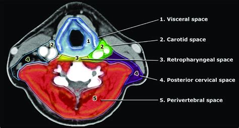 Infrahyoid Neck Spaces Defined By The Deep Cervical Fascia With