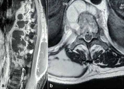 Paraspinal Abscess In Potts Spine In A 35 Year Old Male A T2 Weighted