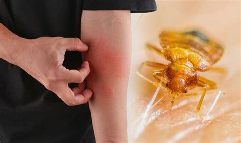 Bed Bug Bites Symptoms Diagnosis Causes And Treatment