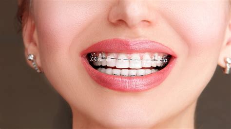 Are Self Ligating Braces A Good Option For Your Child First Impression