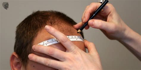 Common Myths Facts To Know About Hair Transplant Ahs India