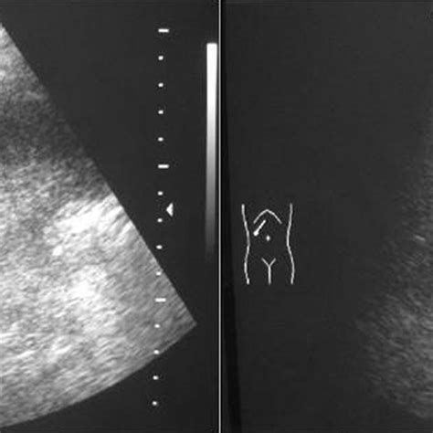 Gallbladder Wall Measurement Ultrasound