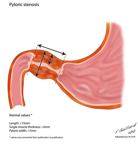 Hypertrophic Pyloric Stenosis Classically Presents As Non Bilious