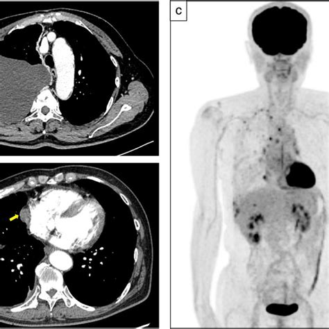 Chest Computed Tomography Ct And Positron Emission Tomography