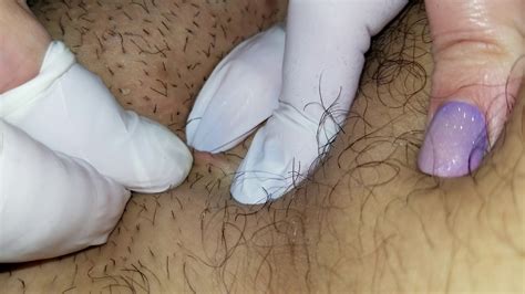 With the many millions of blackhead pore removal products in the market, you might be wondering why you need a natural remedy to get rid of. Pimple popping for pleasure in groin area - clipzui.com