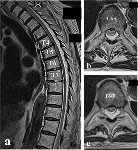 Lateral And Axial T Weighted Mri Scans Of The Lumbar My Xxx Hot Girl