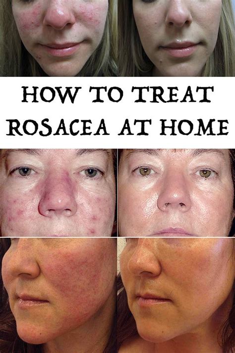How To Treat Rosacea At Home Beauty Enhancers