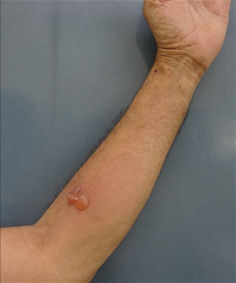Bulla Formation At The Tuberculin Skin Test Site In A Patient With
