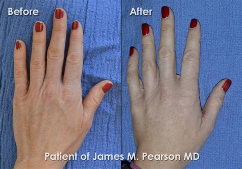 Pearsonmd Hand Rejuvenation Photos Before And After Dr James Pearson