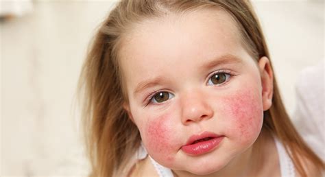 How To Recognise Food Allergies In Children