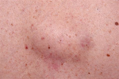 Sebaceous Cyst Stock Image C0345351 Science Photo Library