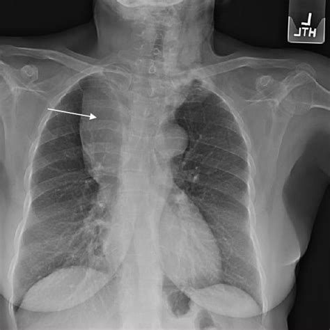 Chest Radiograph Shows A Large Soft Tissue Mass In The Upper Right