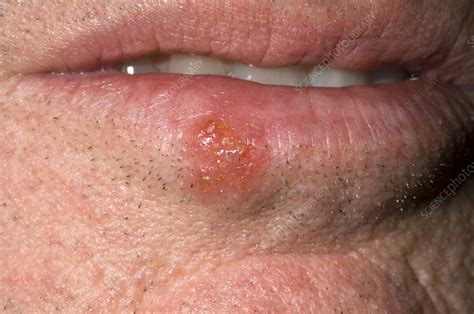 Cold Sore Lesion Stock Image M1700400 Science Photo Library