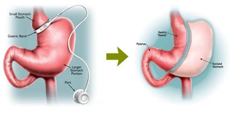 Converting A Gastric Band To A Laparoscopic Gastric Bypass Or Sleeve