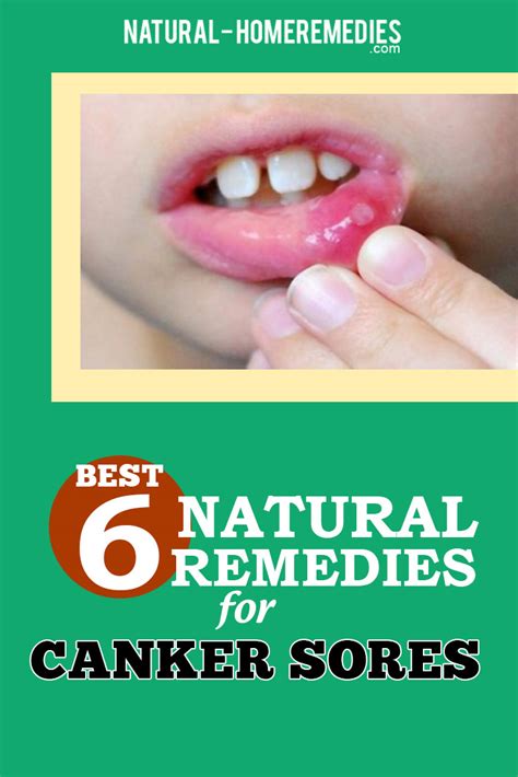 canker sores natural treatments and cures natural home remedies and supplements