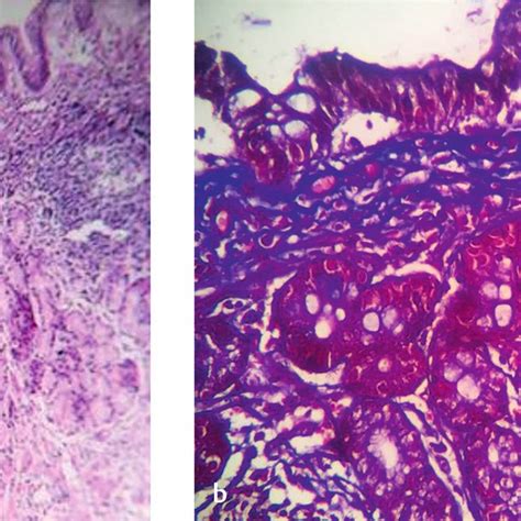 A Endoscopic Examination Showed Nodular Gastric And Duodenal Mucosa