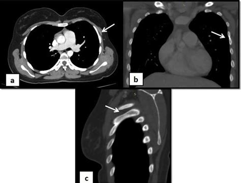 Contrast Enhanced Computed Tomography Ct Chest Shows Normal Bilateral