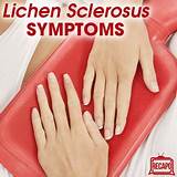 Home Remedies For Vulvar Lichen Sclerosus Pictures