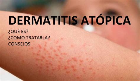 Dermatitis Atópica La Segunda Enfermedad Más Diagnosticada Del Mundo