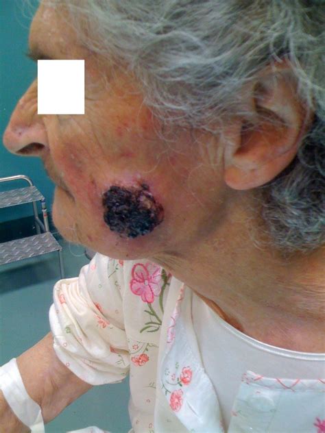Tumori Cutanei e Melanoma | La Chirurgia Plastica