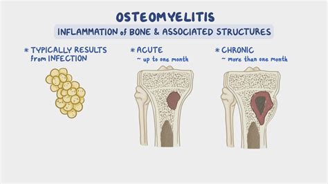 Osteomyelitis Nursing Osmosis Video Library