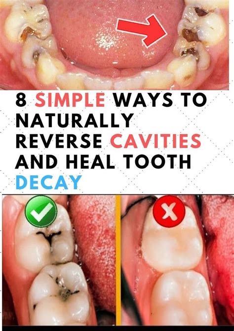 How To Reverse Gum Disease And Tooth Decay Trending Now
