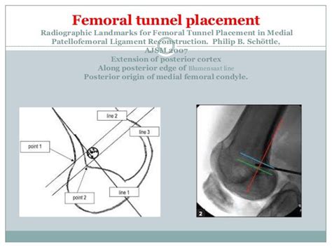 Medial Patellofemoral Ligament Mpfl Reconstruction