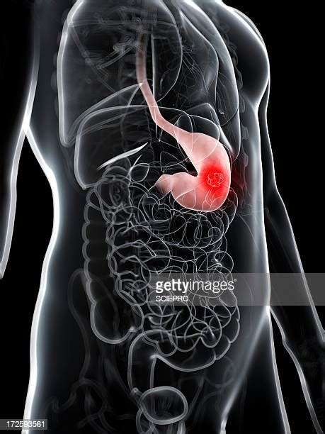 Stomach Cancer Photos And Premium High Res Pictures Getty Images