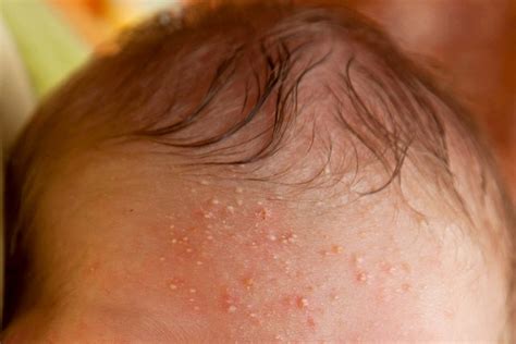 Acne Neonatal O Que é E Como Tratar As Espinhas No Bebê Tua Saúde