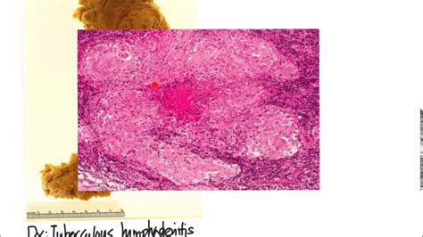 Lymphadenopathy Tb Vs Lymphoma Youtube