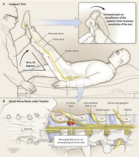 Physical Therapy For Sciatica Nerve