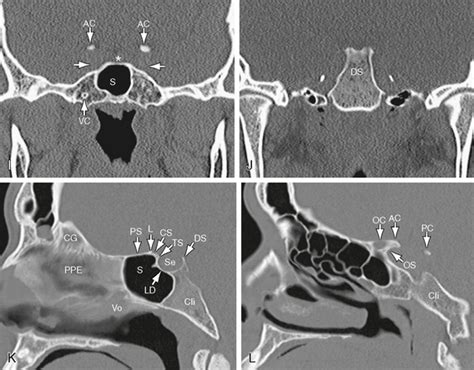 Sella Turcica And Pituitary Gland Radiology Key
