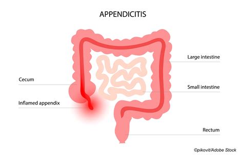 Acute Appendicitis Looking At Treatment Options Beyond Surgery Physicians Weekly
