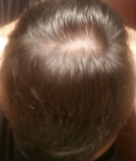 22 Yo Should I Be Worried About Balding From The Crown Malehairadvice